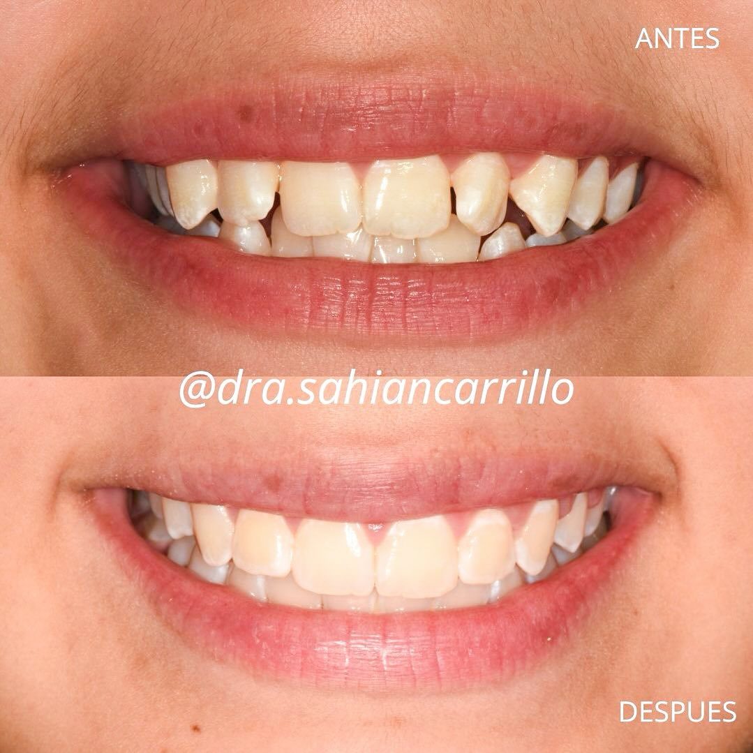 Antes y después tras 12 meses de tratamiento de ortodoncia.