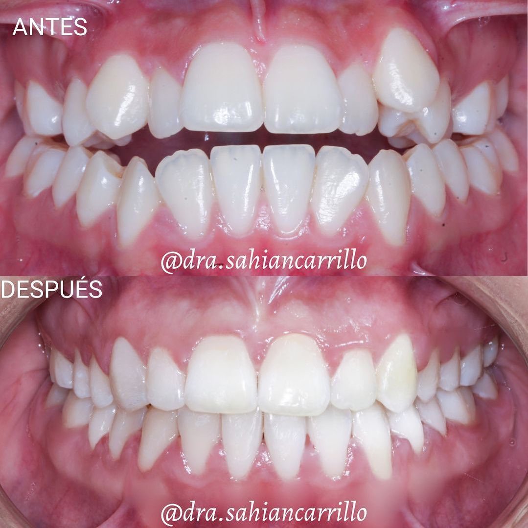 Antes y después de ortodoncia.