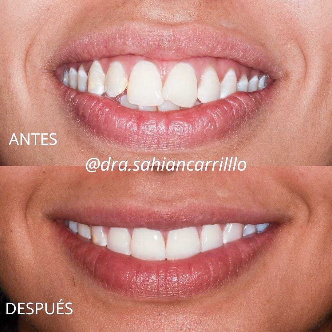 Antes y después: corrección de dientes muy inclinados hacia adelante.
