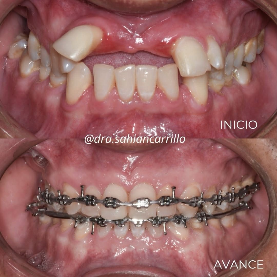 Inicio y avance de un tratamiento con brackets.